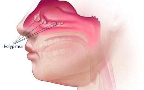 Polyp mũi - Nguyên nhân và cách điều trị