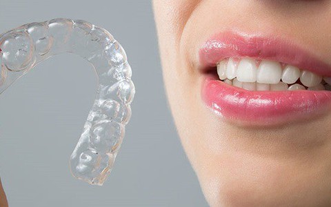 Niềng răng không mắc cài có ưu điểm gì?