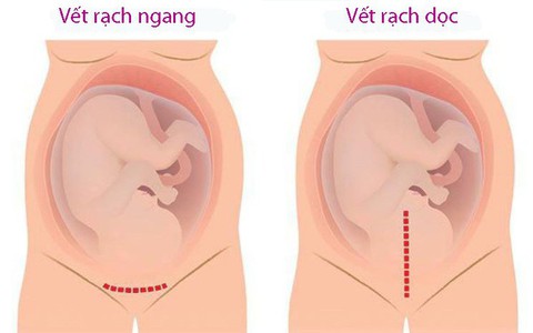 Những câu hỏi thường gặp về sẹo mổ đẻ