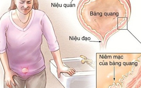 Viêm bàng quang tái lại nhiều lần