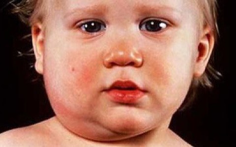 Nên tiêm liều thứ 3 văcxin ngừa quai bị?