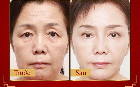 Phương pháp Laser Liposonic xóa nhăn, phục hồi da chảy xệ