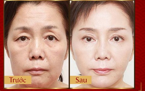 Phương pháp Laser Liposonic xóa nhăn, phục hồi da chảy xệ