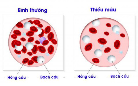 Hội chứng thiếu máu