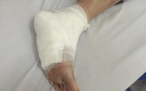 Sưởi đèn đá muối không đúng cách, suýt mất cả đôi chân