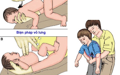 Xử trí trẻ hóc các loại hạt