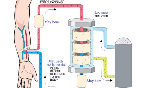 Nguy cơ chạy thận nhân tạo do ăn uống