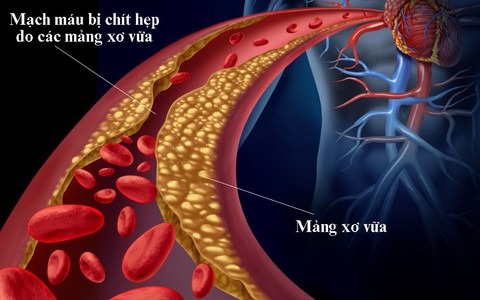Cách ngăn ngừa rối loạn lipid máu