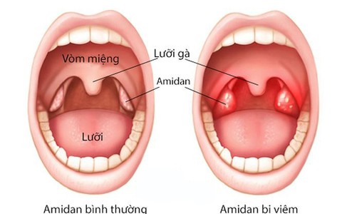 Phòng ngừa amidan “dở chứng”