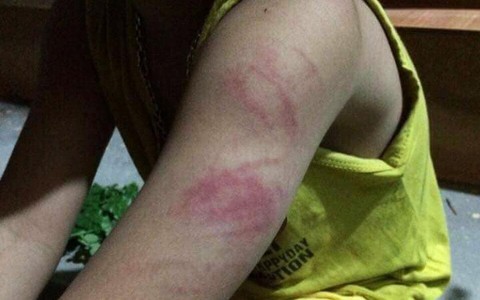 Cô giáo đánh tím tay học sinh lớp 1 vì đọc viết chưa thạo