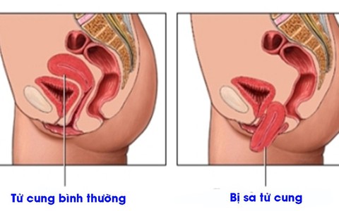 Vài điều cần biết về sa sinh dục