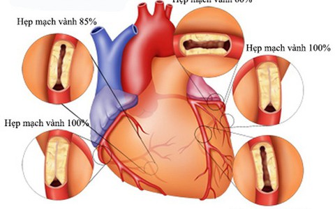 Hiểu biết về bệnh động mạch vành
