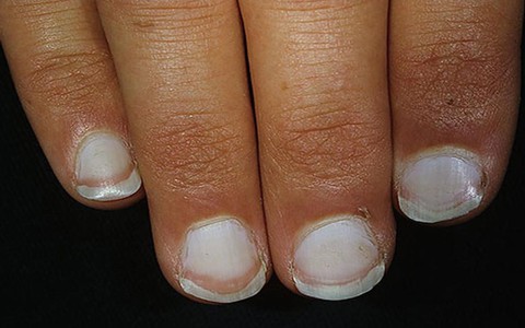 Hội chứng thiếu máu và cách nhận biết