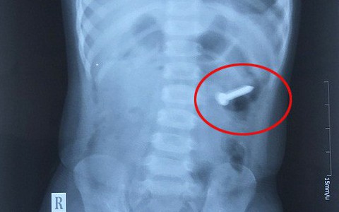 Bé gái 2 tuổi nuốt đinh xoắn 3cm