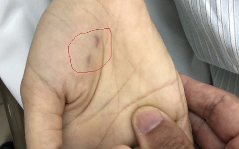 Bị chó dại cắn trong lúc chữa bệnh, nữ bác sĩ thú y trẻ tử vong