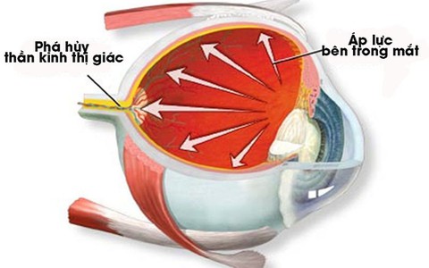 Không chủ quan với bệnh thiên đầu thống