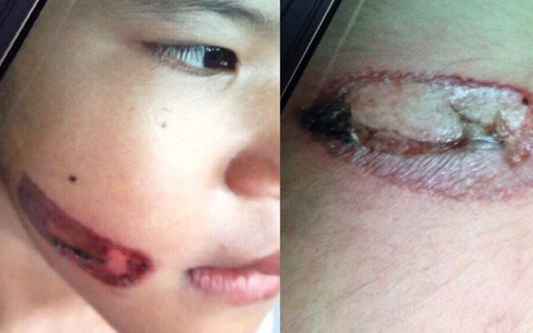 Bé gái nghi bị dí sắt nung đã nghỉ học, vẫn ở với cha