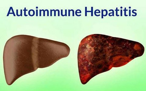Viêm gan tự miễn trẻ em