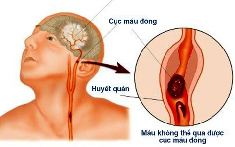 Bệnh nhồi máu não