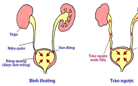 Bệnh trào ngược bàng quang - niệu quản ở trẻ em