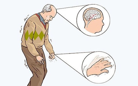 Bệnh Parkinson, người cao tuổi nên biết
