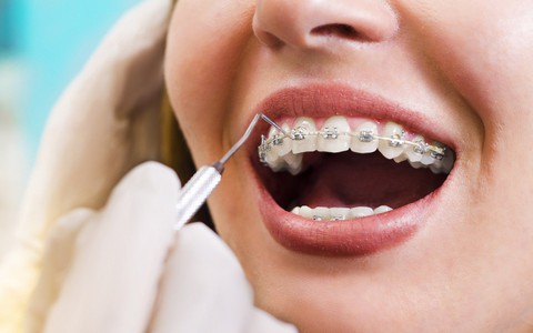 Vì sao cần nắn chỉnh răng?