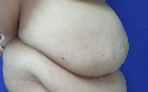 Cắt hơn 6 kg da và mỡ bụng cho nữ bệnh nhân có mỡ xếp thành lớp