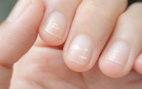 Móng tay bé bị đốm trắng có ý nghĩa gì?