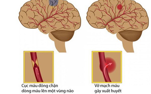Bác sĩ 'phản ứng nhanh' trên Viber, cứu sống người đột quỵ sau 30 phút