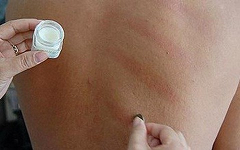 Lương y chỉ cách cạo gió đúng cách, không đau