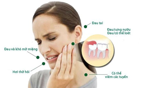 Giảm đau khi mọc răng khôn