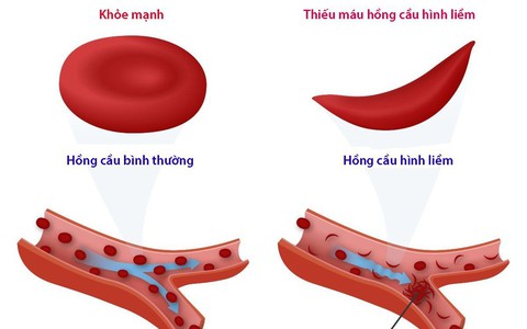 Bệnh thiếu máu hồng cầu hình liềm ở trẻ nhỏ