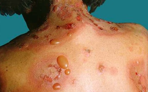 Bệnh da bọng nước tự miễn
