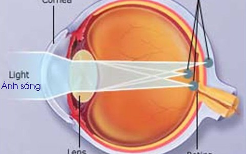 Loạn thị, nguyên nhân và cách điều trị