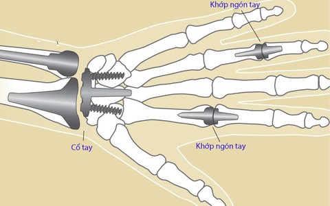 Viêm khớp ngón tay