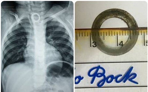Bé 2 tuổi nuốt phải chiếc vòng kim loại có cạnh sắc