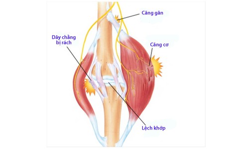 4 nhóm chấn thương thể thao thường gặp nhất