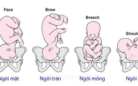 Sinh khó: Các vấn đề về đường dẫn sinh