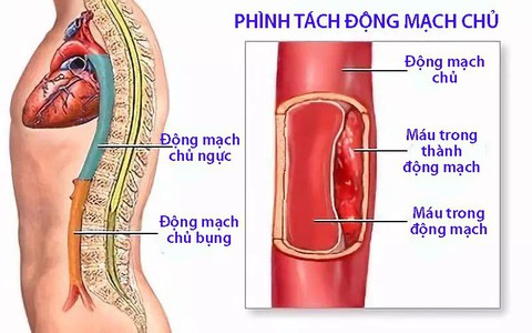Bệnh phình tách thành động mạch chủ
