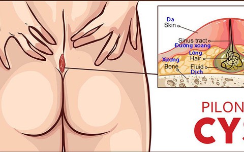 Bệnh nang lông dưới da vùng xương cùng cụt - xoang lông