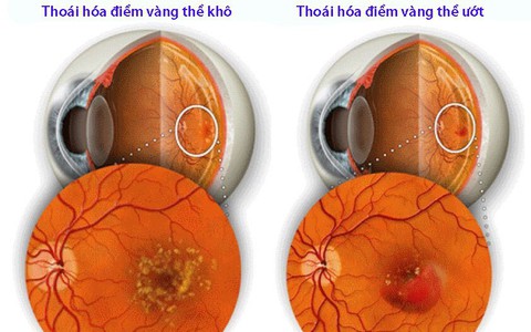 Những hiểu lầm về bệnh thoái hóa điểm vàng thể ướt