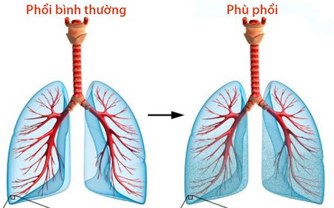 Phù phổi