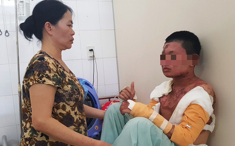 Nam sinh bị bỏng nặng vì bếp cồn trước ngày thi THPT