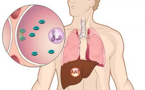 Bệnh thiếu hụt men Alpha-1-Antitripsin