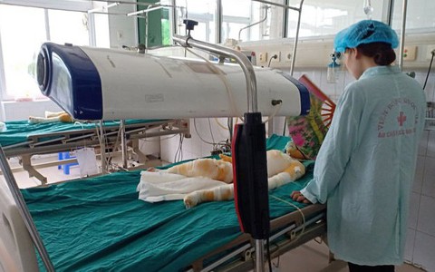 Tình hình sức khỏe 3 trẻ bị bỏng do cồn: Bác sĩ bảo 'chưa nói trước được'