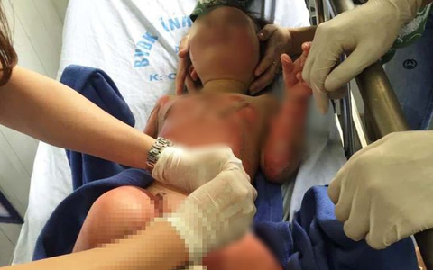 Cô giáo đốt cồn dạy phòng chống cháy nổ làm 3 trẻ mầm non bỏng nặng