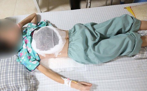 Dùng thuốc nam chữa ung thư, nữ bệnh nhân bị hoại tử một bên ngực