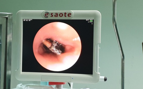 Hạt sapôchê nằm 27 năm trong phế quản người phụ nữ