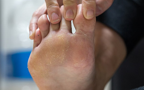 Phủ nano trên vớ để trị hôi chân