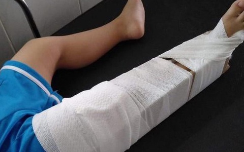 Tạm đình chỉ cô giáo làm bé 3 tuổi gãy xương đùi trong lớp